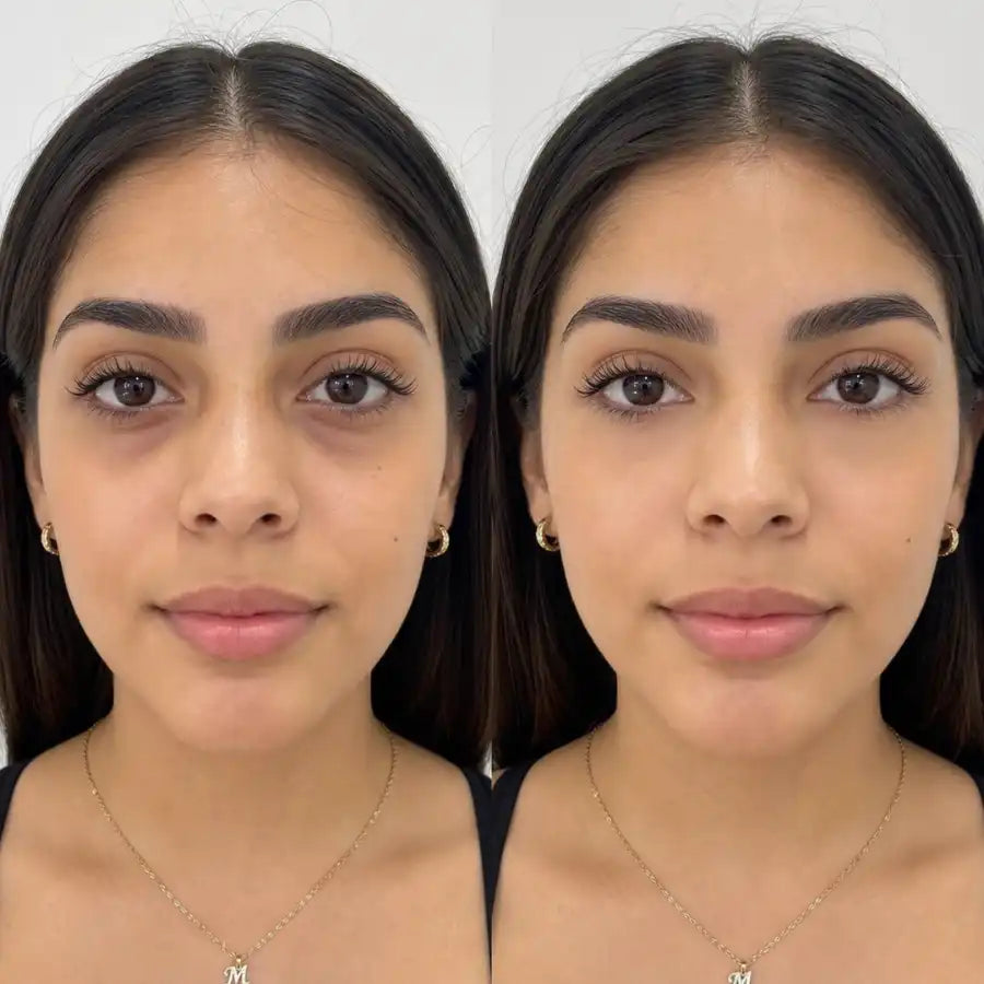 Antes y después del uso de contorno de ojos para mejorar la apariencia de ojeras, bolsas y mirada cansada.